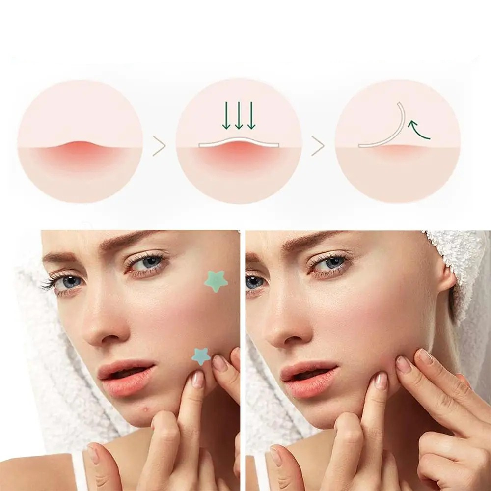 Star Acne Patches (200pcs)
