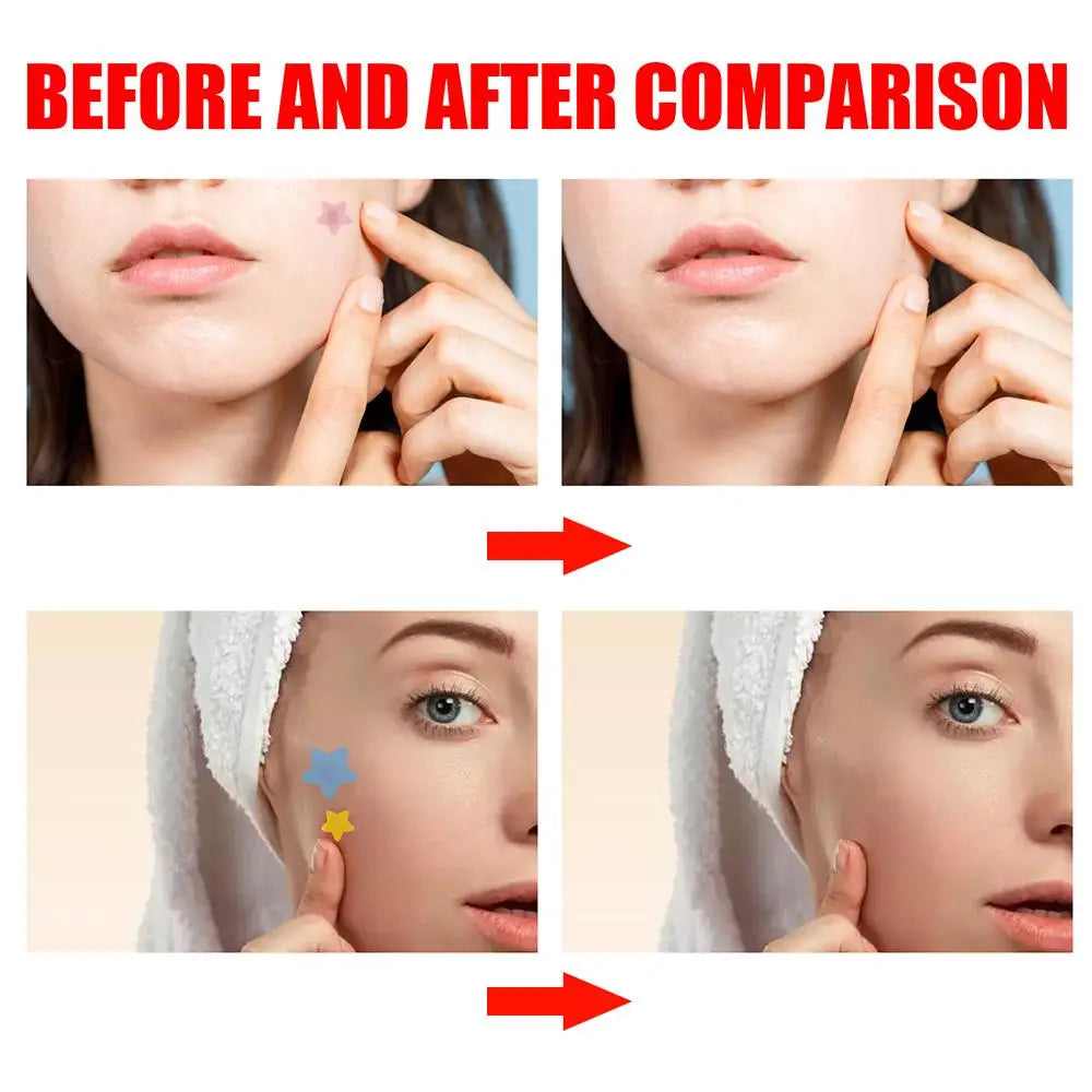 Star Acne Patches (200pcs)